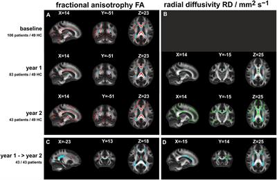 Temporal Dynamics of Diffusion Metrics in Early Multiple Sclerosis and Clinically Isolated Syndrome: A 2-Year Follow-Up Tract-Based Spatial Statistics Study